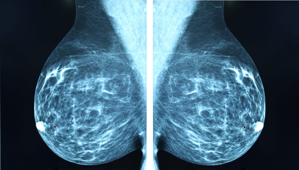 Mammography Advanced Studies